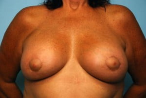 Breast Surgery Breast Lift with Augmentation