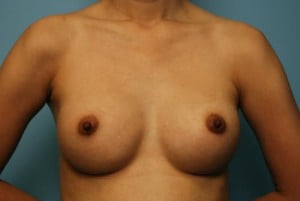 Breast Surgery Breast Augmentation