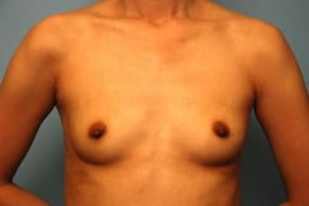 Breast Surgery Breast Augmentation