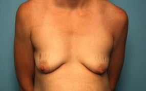 Breast Surgery Breast Lift with Augmentation