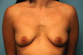 Breast Surgery Breast Lift with Augmentation