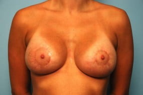 Breast Surgery Breast Lift with Augmentation