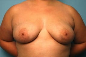 Breast Surgery Breast Augmentation