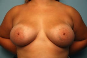 Breast Surgery Breast Augmentation