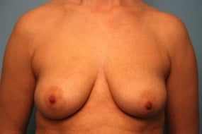 Breast Surgery Breast Asymmetry Correction