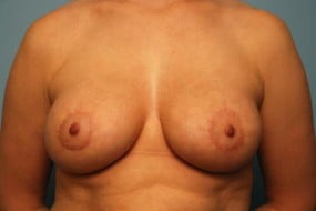 Breast Surgery Breast Asymmetry Correction