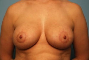 Breast Surgery Breast Asymmetry Correction
