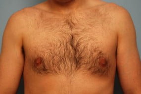 Male Breast Reduction