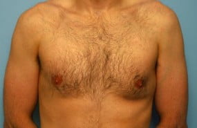 Male Breast Reduction