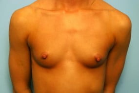 Breast Surgery Breast Augmentation