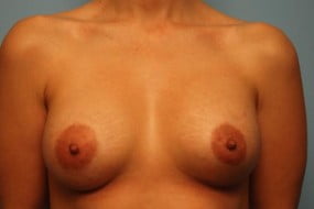 Breast Surgery Breast Augmentation