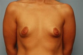 Breast Surgery Breast Augmentation