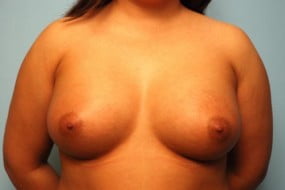 Breast Surgery Breast Augmentation