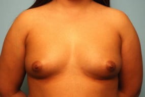 Breast Surgery Breast Augmentation