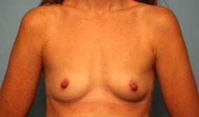 Breast Surgery Breast Augmentation