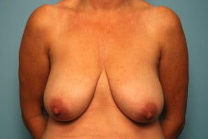 Breast Surgery Breast Reduction