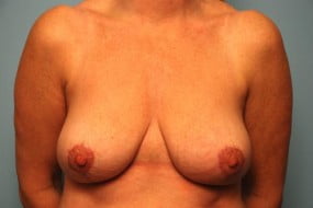 Breast Surgery Breast Reduction