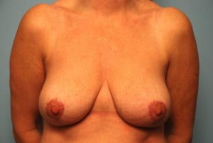 Breast Surgery Breast Reduction
