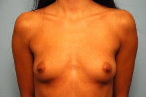 Breast Surgery Breast Augmentation