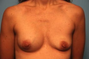 Breast Surgery Breast Implant Removal
