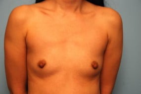 Breast Surgery Breast Augmentation