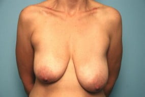 Breast Surgery Breast Asymmetry Correction