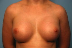 Breast Surgery Breast Augmentation