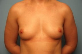 Breast Surgery Breast Augmentation