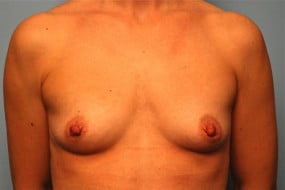 Breast Surgery Breast Augmentation