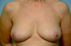 Breast Surgery Breast Implant Removal