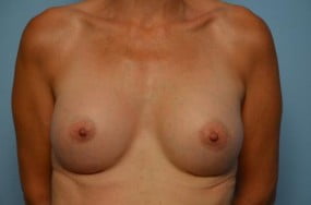 Breast Surgery Breast Augmentation