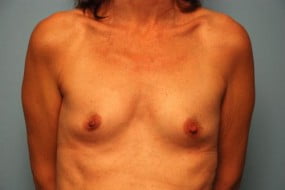 Breast Surgery Breast Augmentation