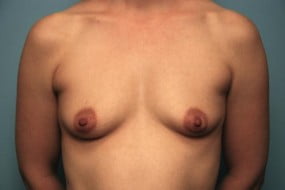 Breast Surgery Breast Augmentation