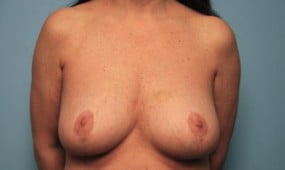 Breast Surgery Breast Reduction