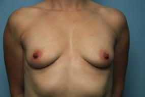 Breast Surgery Breast Lift with Augmentation