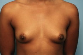 Breast Surgery Breast Augmentation