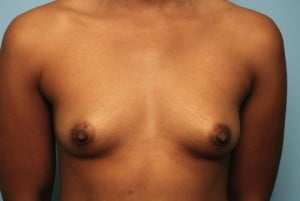 Breast Surgery Breast Augmentation