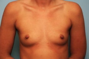 Breast Surgery Breast Augmentation