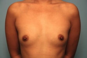 Breast Surgery Breast Augmentation