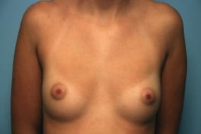 Breast Surgery Breast Augmentation