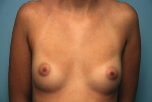 Breast Surgery Breast Augmentation