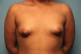 Breast Surgery