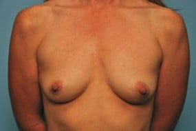 Breast Surgery Breast Augmentation