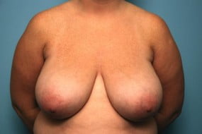 Breast Surgery Breast Reduction