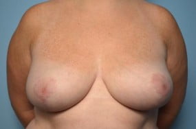 Breast Surgery Breast Reduction