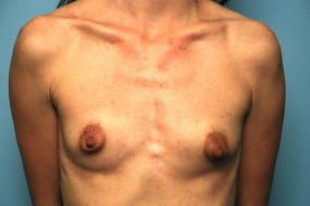 Breast Surgery Breast Augmentation