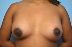 Breast Surgery