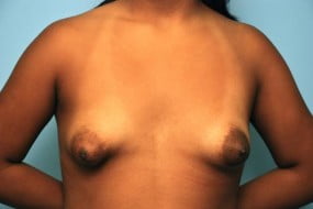 Breast Surgery