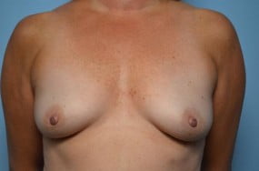 Breast Surgery Breast Augmentation