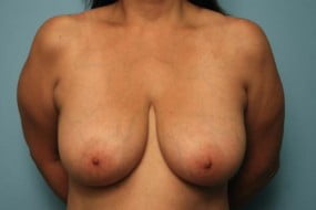 Breast Surgery Breast Lift